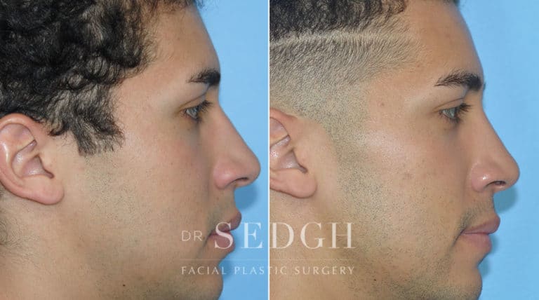 Crooked Nose Surgery Before and After | Sedgh