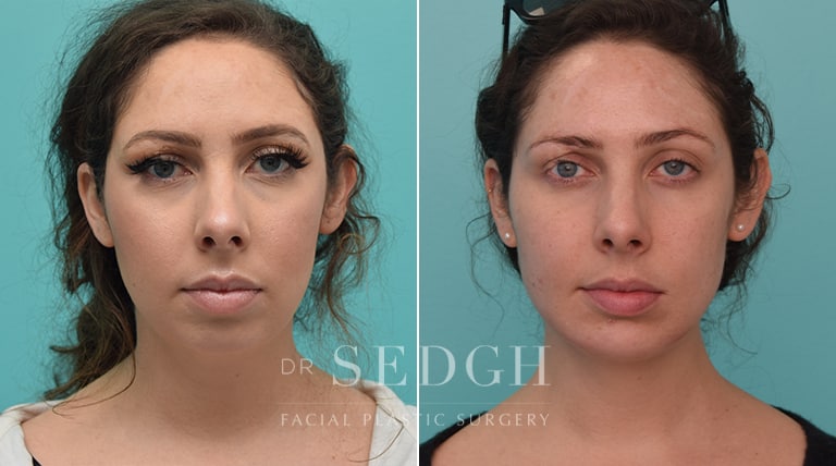 Facial Fillers Before and After | Sedgh