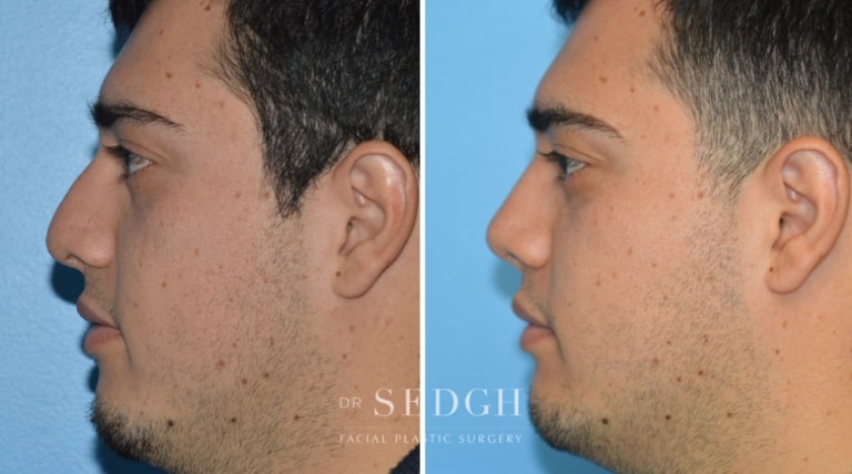 Nasal Fracture Before and After | Sedgh