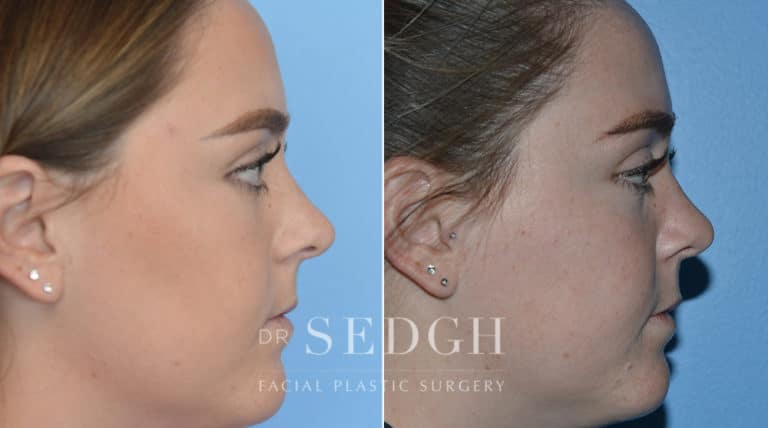 Crooked Nose Surgery Before and After | Sedgh