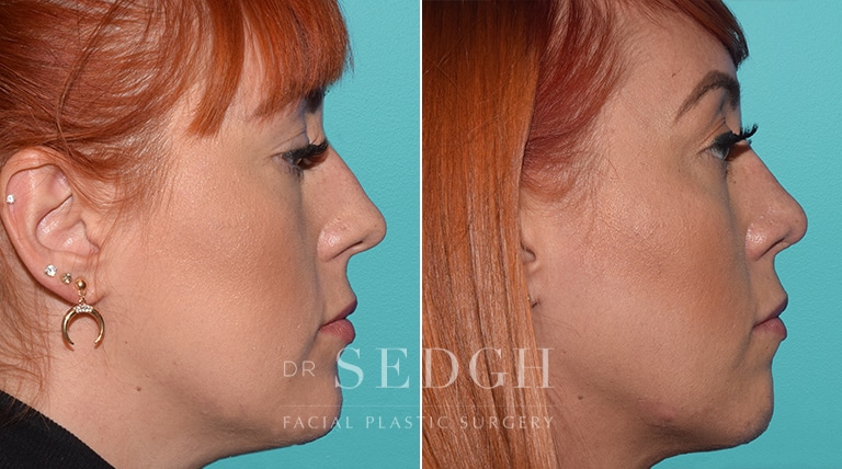 Rhinoplasty Before and After | Sedgh