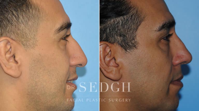 Rhinoplasty Before and After | Sedgh