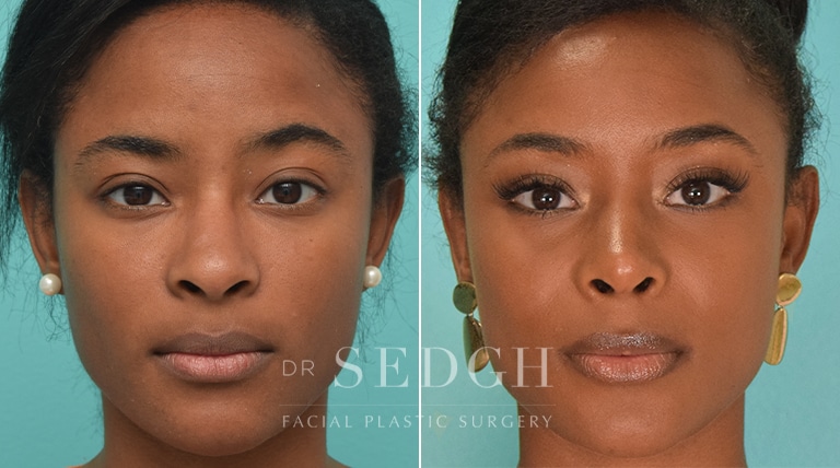 Rhinoplasty Before and After | Sedgh