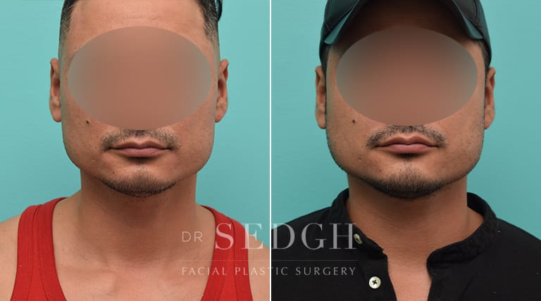 Facial Fillers Before and After | Sedgh