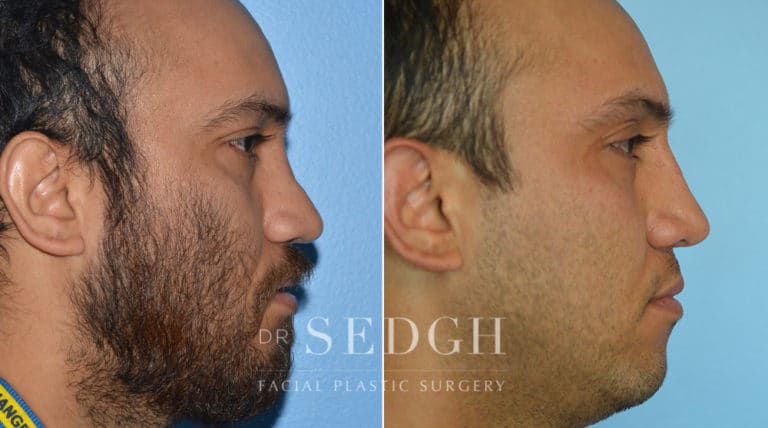 Crooked Nose Surgery Before and After | Sedgh