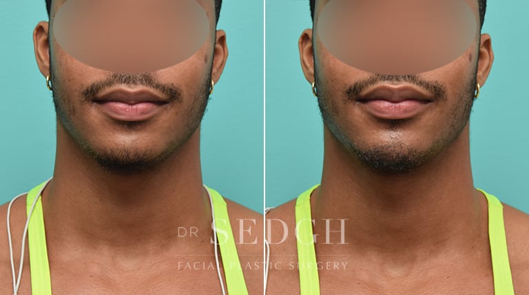 Facial Fillers Before and After | Sedgh