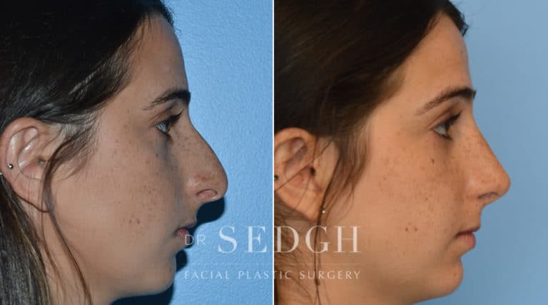 Crooked Nose Surgery Before and After | Sedgh