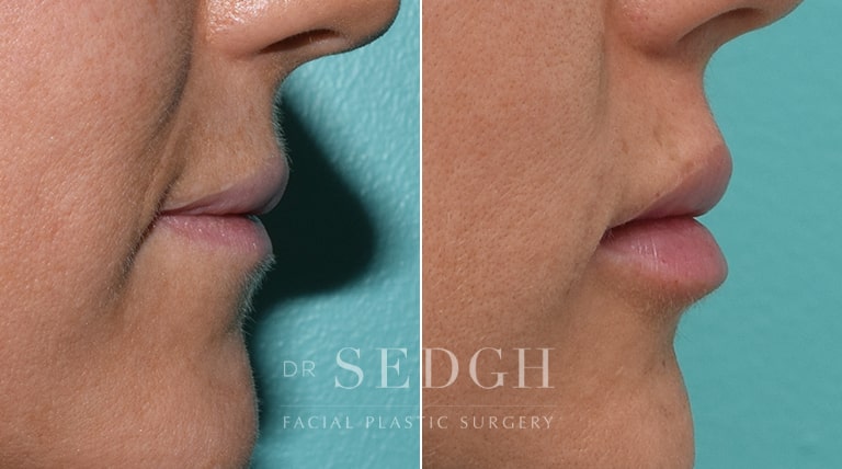 Lip Augmentation Before and After | Sedgh