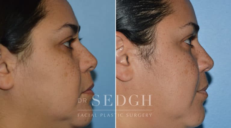 Crooked Nose Surgery Before and After | Sedgh