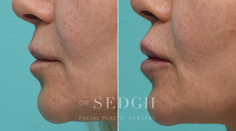 Lip Augmentation Before and After | Sedgh