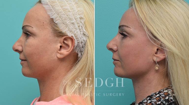 Laser Skin Treatments Before and After | Sedgh