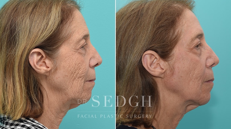 Laser Skin Treatments Before and After | Sedgh