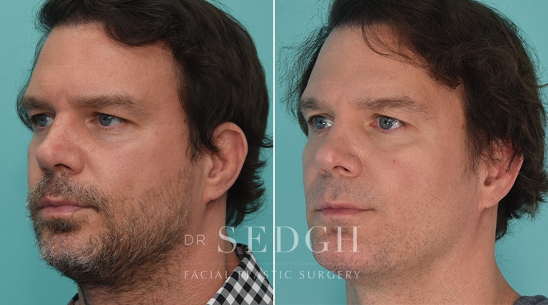 Chin Augmentation Before and After | Sedgh