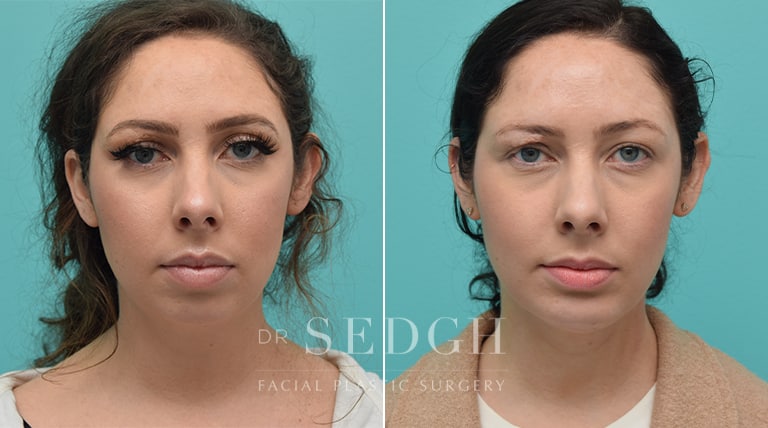 Chin Augmentation Before and After | Sedgh