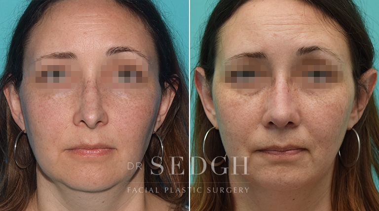 Female Rhinoplasty Before and After | Sedgh