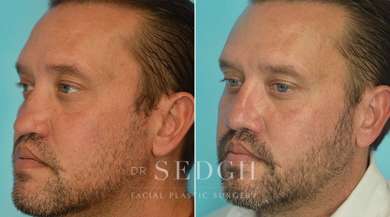 Rhinoplasty Before and After | Sedgh