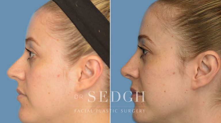 Rhinoplasty Before and After | Sedgh