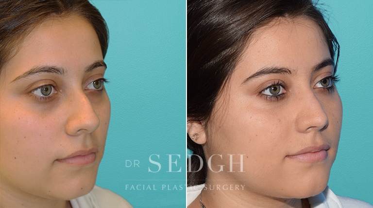 Female Rhinoplasty Before and After | Sedgh