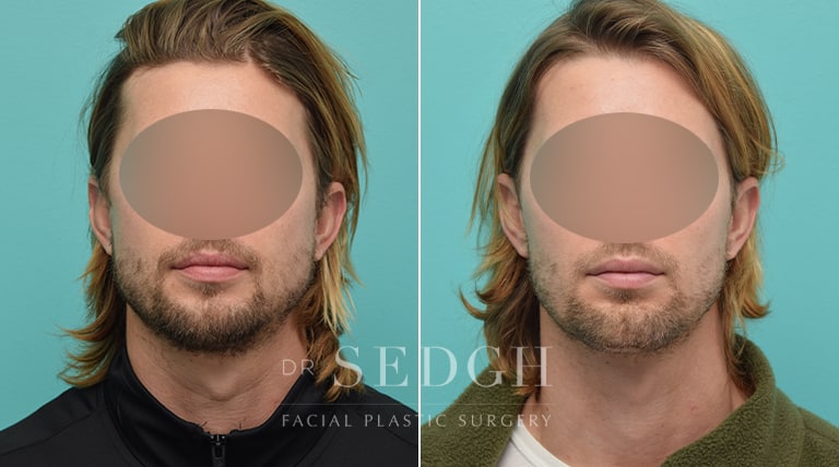 Chin Augmentation Before and After | Sedgh