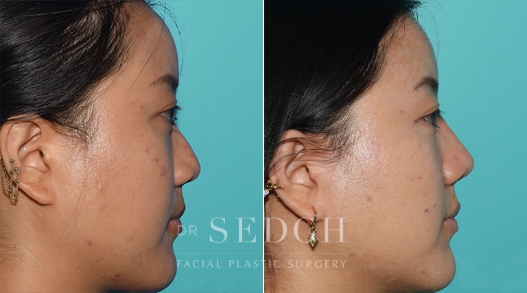 Female Rhinoplasty Before and After | Sedgh