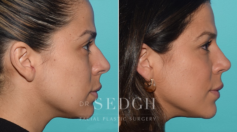 Premium Photo  Transformation of woman's nose through rhinoplasty