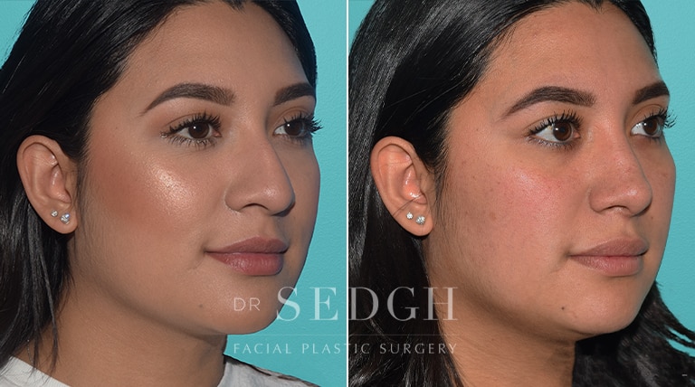 Female Rhinoplasty Before and After | Sedgh