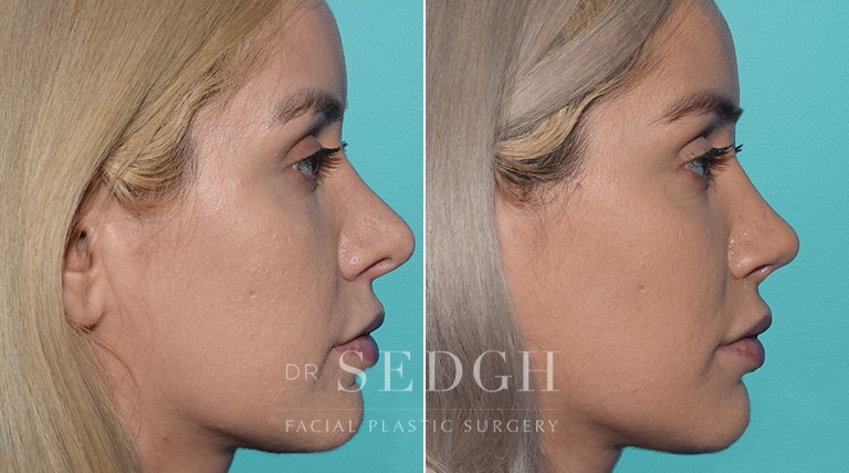 Female Rhinoplasty Before and After | Sedgh