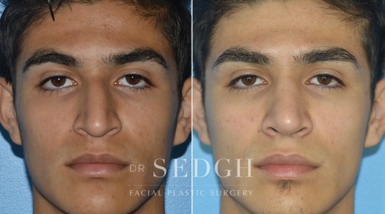 Rhinoplasty Before and After | Sedgh