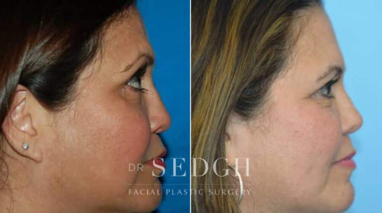 Female Rhinoplasty Before and After | Sedgh