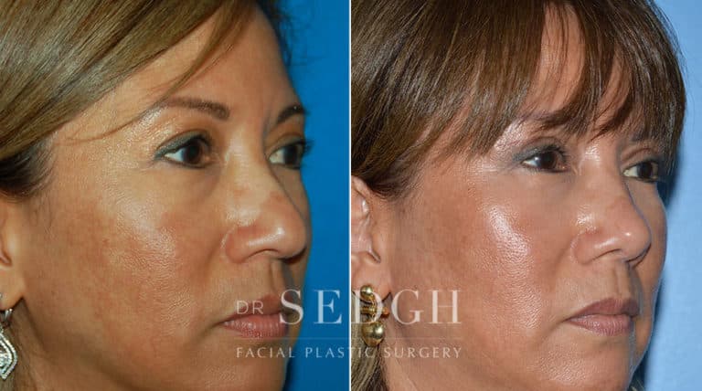 Female Rhinoplasty Before and After | Sedgh