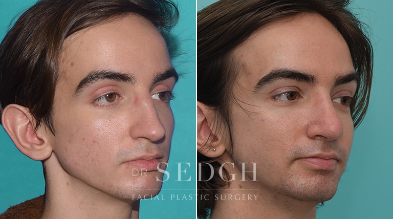 Male Rhinoplasty Before and After | Sedgh