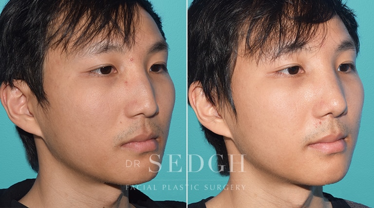 Male Rhinoplasty Before and After | Sedgh