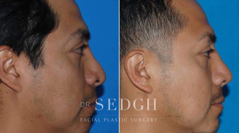 Latino Rhinoplasty Before and After | Sedgh