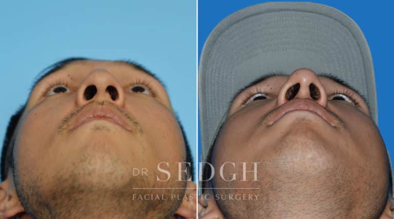 Asian Rhinoplasty Before and After | Sedgh