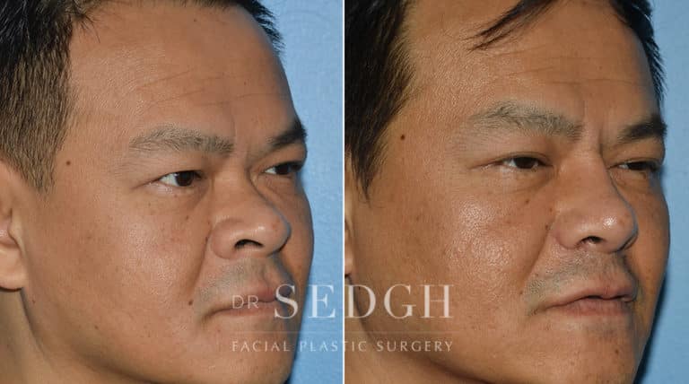 Asian Rhinoplasty Before and After | Sedgh