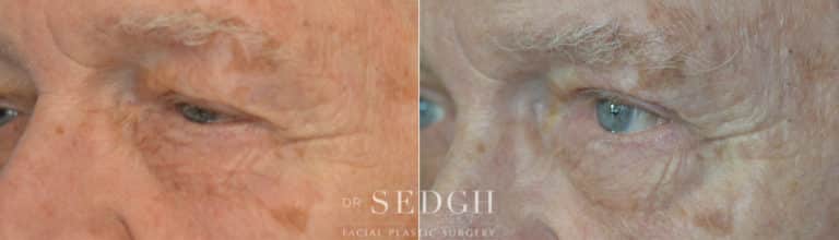 Upper Blepharoplasty Before and After | Sedgh