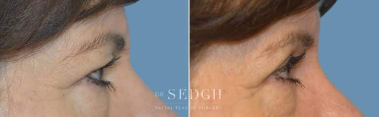 Upper Blepharoplasty Before and After | Sedgh