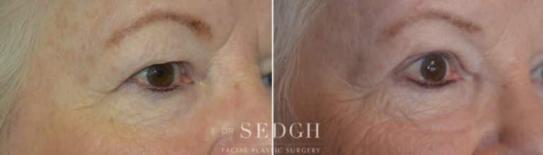 Upper Blepharoplasty Before and After | Sedgh