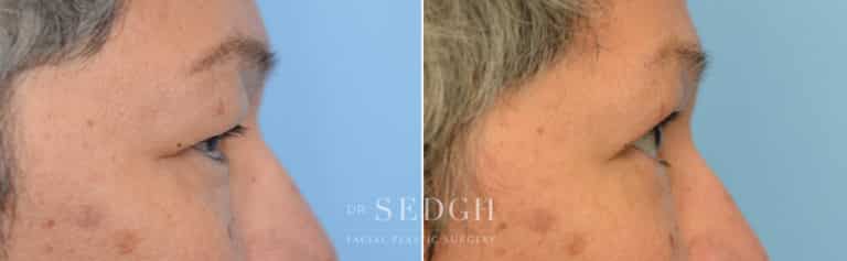 Upper Blepharoplasty Before and After | Sedgh