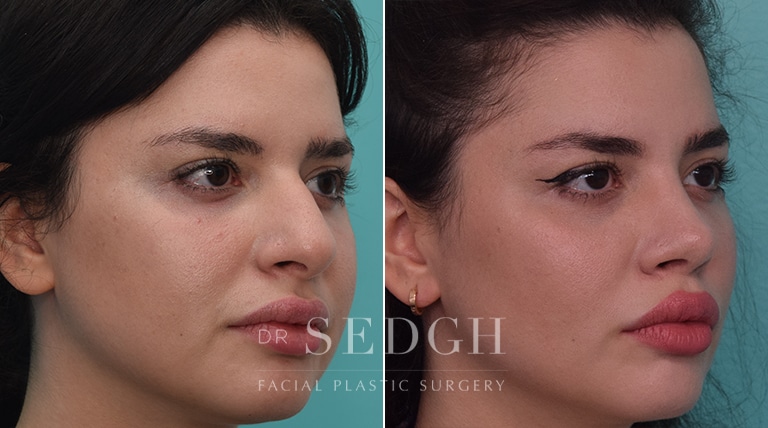 Rhinoplasty Before and After | Sedgh