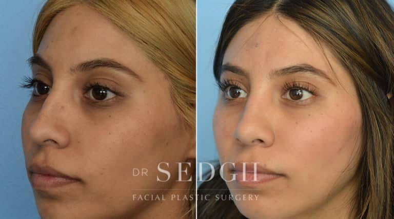 Rhinoplasty Before and After | Sedgh