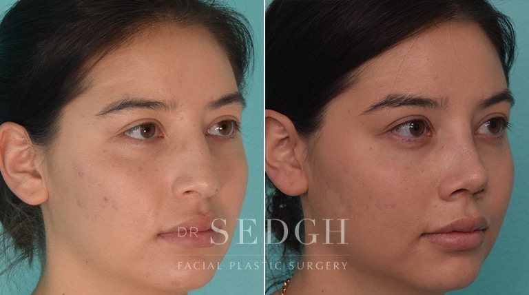 Rhinoplasty Before and After | Sedgh