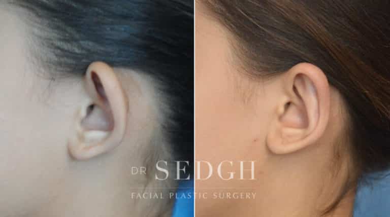 Ear Pinning Surgery Before and After | Sedgh