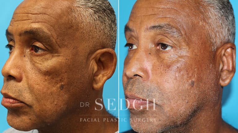 Ear Pinning Surgery Before and After | Sedgh