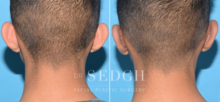 Ear Pinning Surgery Before and After | Sedgh