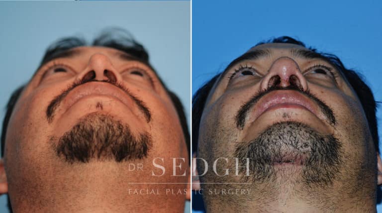 Neck Liposuction Before and After | Sedgh