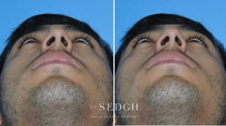 Rhinoplasty Before and After | Sedgh