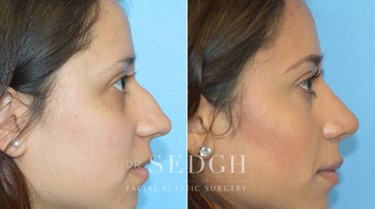 Rhinoplasty Before and After | Sedgh