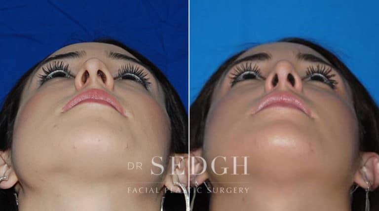 Rhinoplasty Before and After | Sedgh