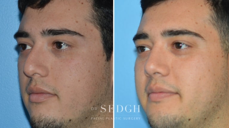 Rhinoplasty Before and After | Sedgh